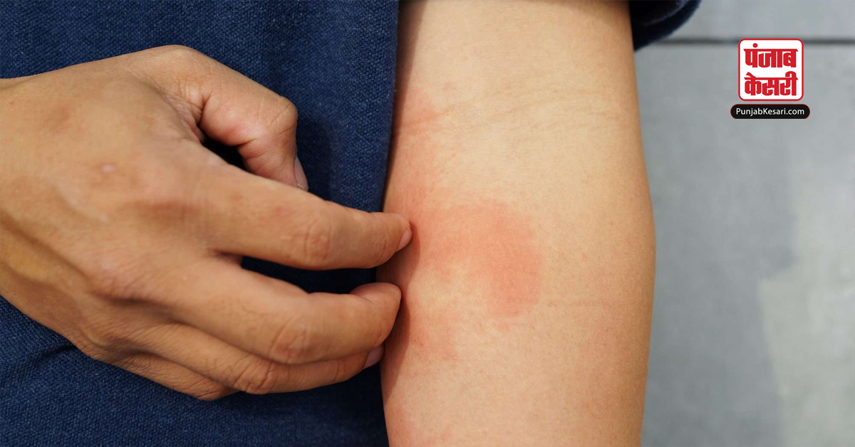 Skin Dermatitis
