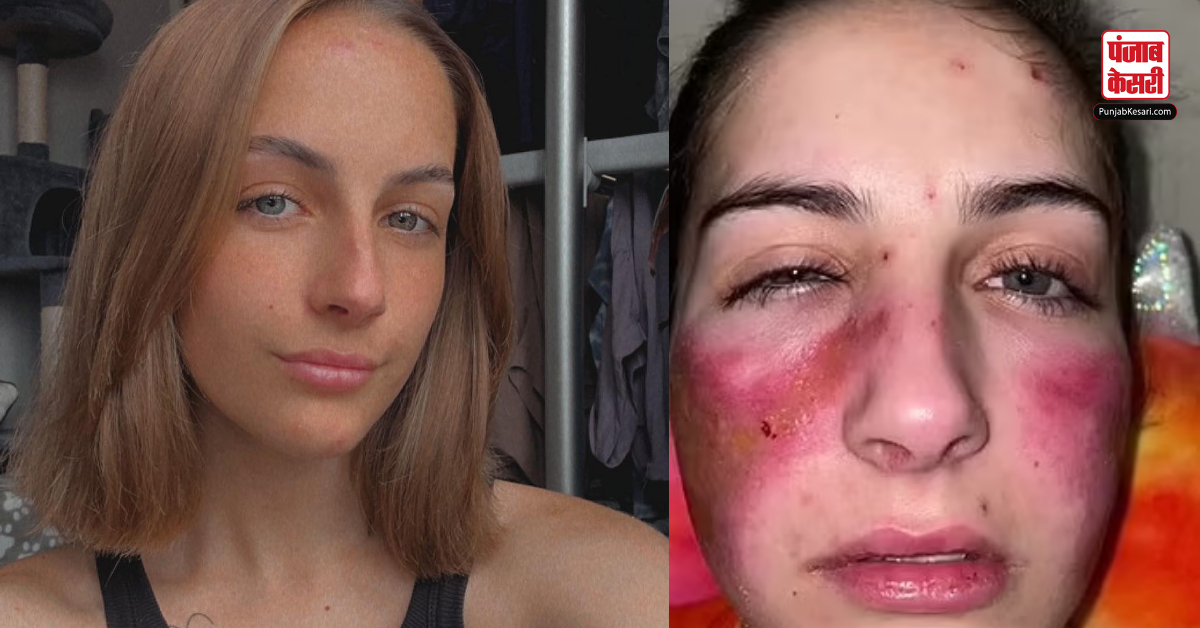 Woman allergic to herself