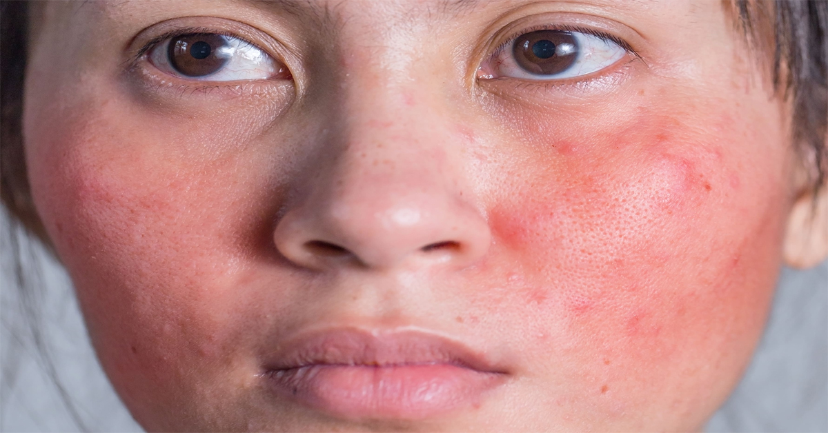 Face Redness