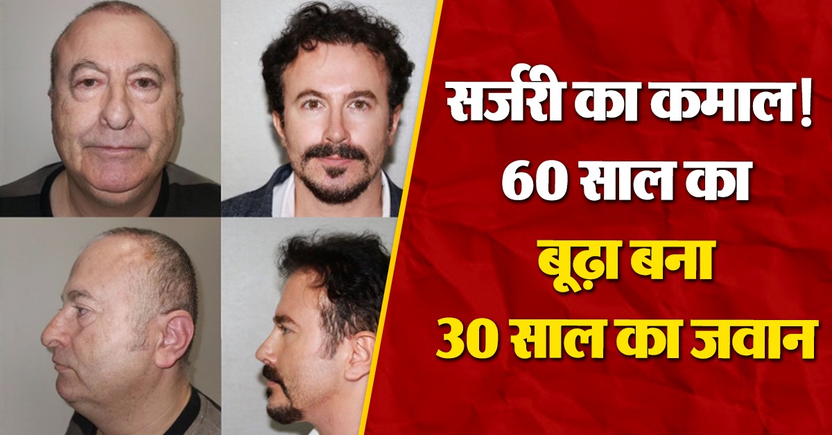 30 Years Younger Surgery