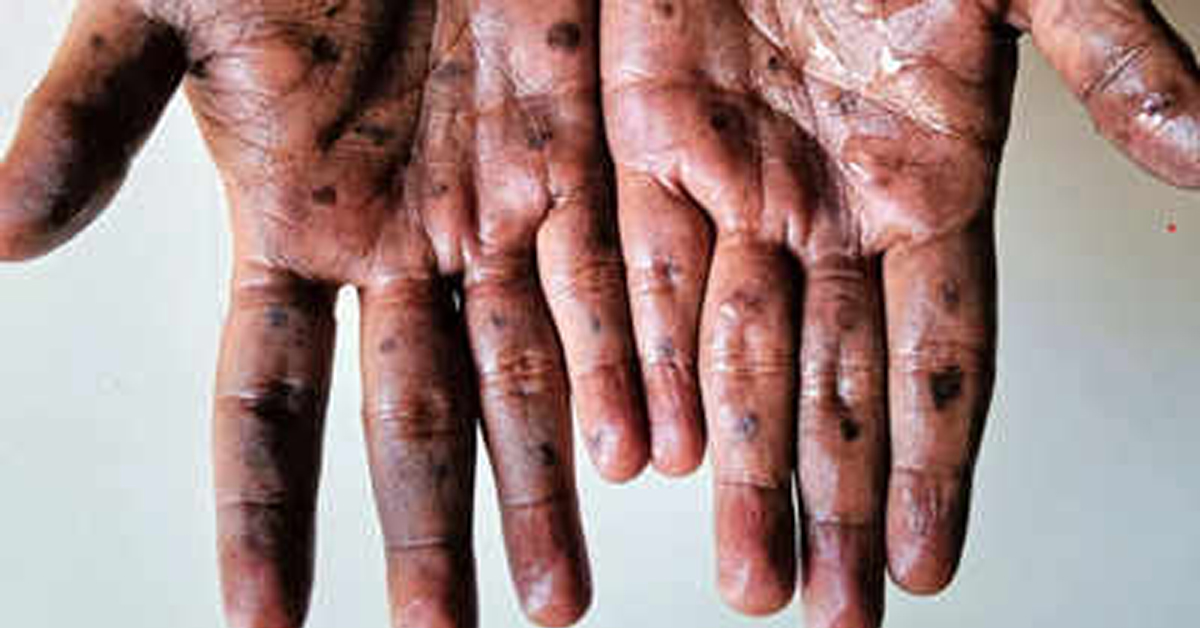 Mpox Outbreak 2024
