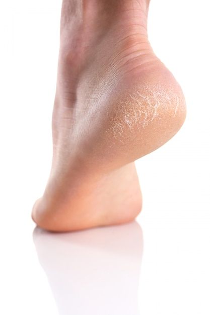 1362051 Cracked Heels 3