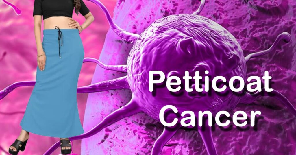 1362987 petticoat cancer