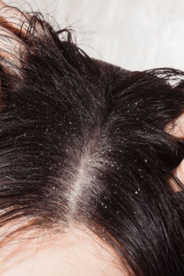 1372459 7 Home Remedies To Treat Dandruff Naturally