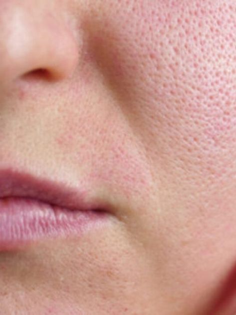 1374549 10 Simple Home Remedies To Get Rid Of Open Pores On Skin Beauty Epic