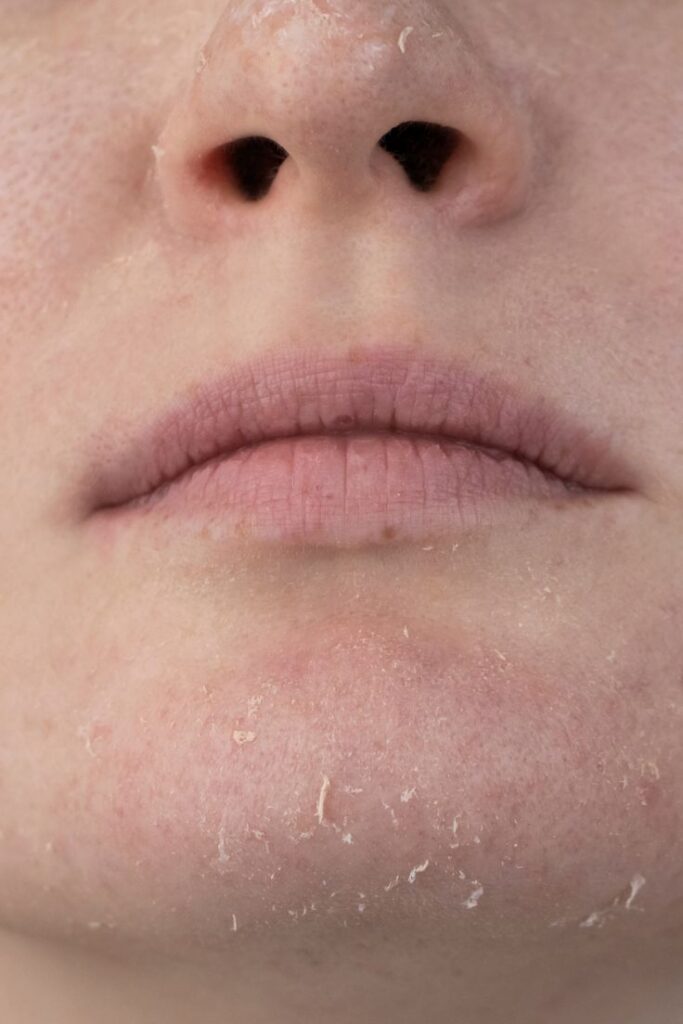 1381507 4 Solutions for Dry Cracked Skin