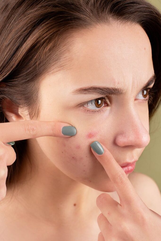 1383723 pimples