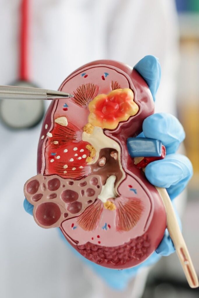 1385975 The Hidden Impact Of Oxalates On Kidney Health What You Need To Know