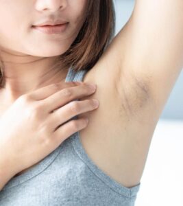 Dark Underarms Remedies: अंडरआर्म्स के कालेपन को कहें अलविदा, अपने ये घरेलू उपाय