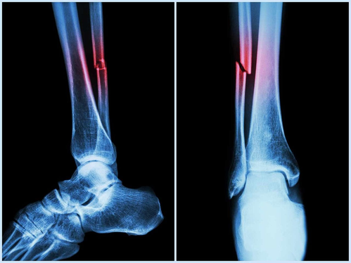 1397489 Fracture scaled
