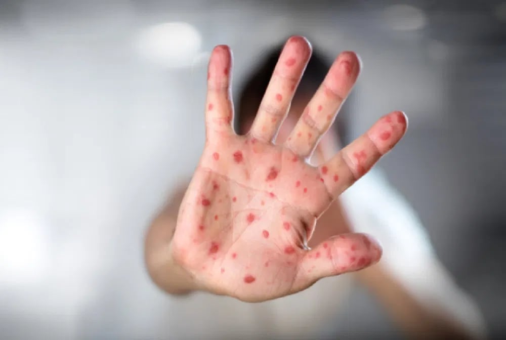 1398605 Measles