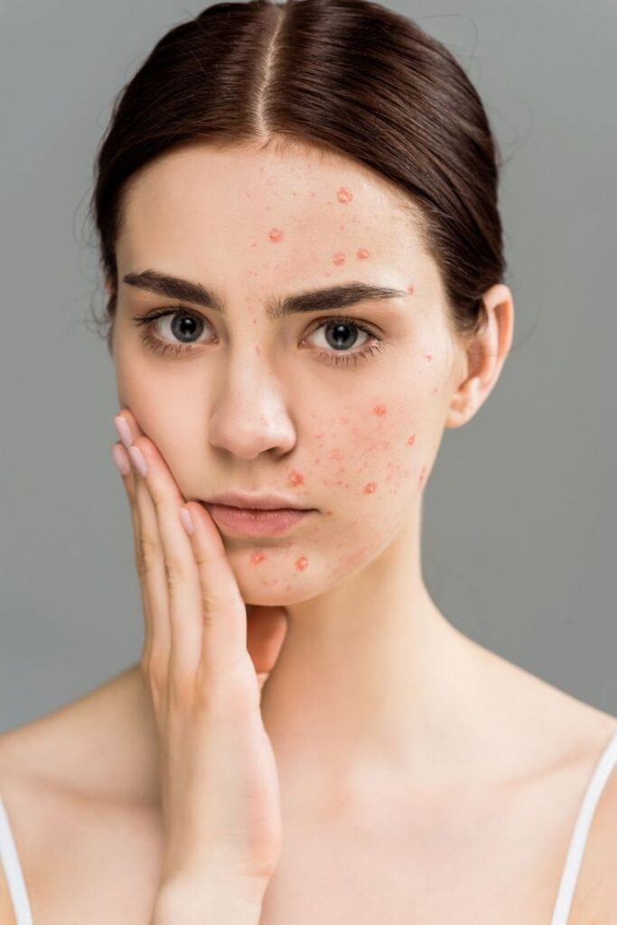 1399576 acne