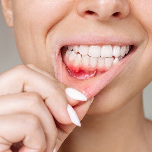 1400821 Mouth Ulcer Treatment Market Report 2025 2033
